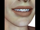 Braces (or 'Retainer') for V4's teeth