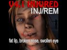 V4 Injured