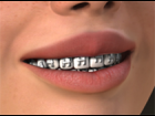 Laura/SP3/V3 Braces