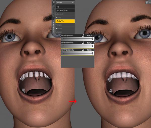 Teeth Adjustments- Genesis Teens DS4.5 (Updated)