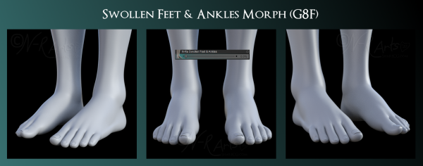 N-Ra Swollen Feet and Ankles Morph