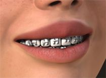 Laura/SP3/V3 Braces